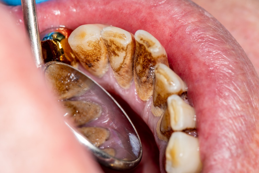 tártaro enegrecido e placa nos dentes